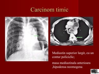 Carcinom timicCarcinom timic
Mediastin superior largit, cu un
contur policiclic;
masa mediastinala anterioara
,hipodensa neomogena
 