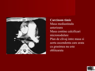 Carcinom timic
Masa mediastinala
anterioara
Masa contine calcificari
micronodulare
Plan de clivaj intre masa si
aorta ascendenta care arata
ca grasimea nu este
oblitearata
 