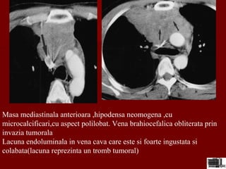 Masa mediastinala anterioara ,hipodensa neomogena ,cu
microcalcificari,cu aspect polilobat. Vena brahiocefalica obliterata prin
invazia tumorala
Lacuna endoluminala in vena cava care este si foarte ingustata si
colabata(lacuna reprezinta un tromb tumoral)
 