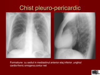 Chist pleuro-pericardicChist pleuro-pericardic
Formatiune cu sediul in mediastinul anterior etaj inferior ,unghiul
cardio-frenic omogena,contur net
 