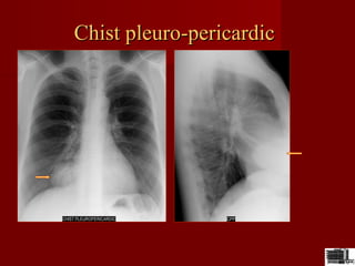 Chist pleuro-pericardicChist pleuro-pericardic
 
