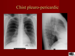 Chist pleuro-pericardicChist pleuro-pericardic
 