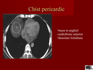 Chist pericardicChist pericardic
•masa in unghiul
cardiofrenic anterior
•densitate lichidiana
 