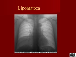 Lipomatoza
 