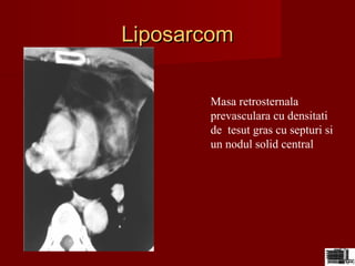 LiposarcomLiposarcom
Masa retrosternala
prevasculara cu densitati
de tesut gras cu septuri si
un nodul solid central
 