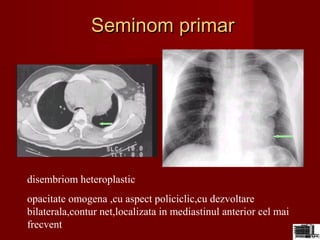 Seminom primarSeminom primar
disembriom heteroplastic
opacitate omogena ,cu aspect policiclic,cu dezvoltare
bilaterala,contur net,localizata in mediastinul anterior cel mai
frecvent
 