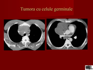 Tumora cu celule germinaleTumora cu celule germinale
 