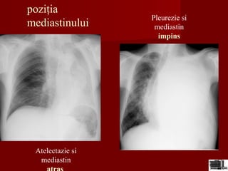 poziţia
mediastinului
Atelectazie si
mediastin
Pleurezie si
mediastin
impins
 