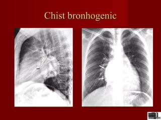Chist bronhogenicChist bronhogenic
 