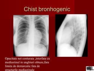 ChistChist bronhogenicbronhogenic
Opacitate net conturata ,interfata cu
mediastinul in unghiuri obtuze,fara
limita de demarcatie fata de
structurile mediastinale
 