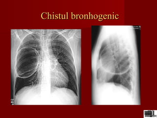 Chistul bronhogenicChistul bronhogenic
 