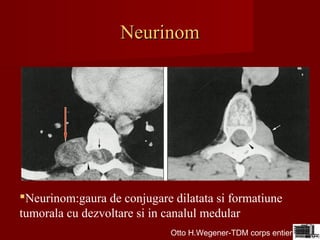 NeurinomNeurinom
Neurinom:gaura de conjugare dilatata si formatiune
tumorala cu dezvoltare si in canalul medular
Otto H.Wegener-TDM corps entier
 