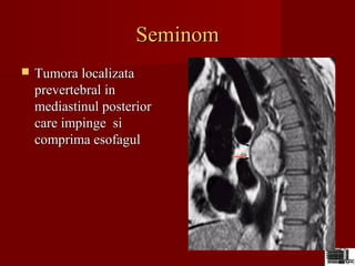 SeminomSeminom
 Tumora localizataTumora localizata
prevertebral inprevertebral in
mediastinul posteriormediastinul posterior
care impinge sicare impinge si
comprima esofagulcomprima esofagul
 