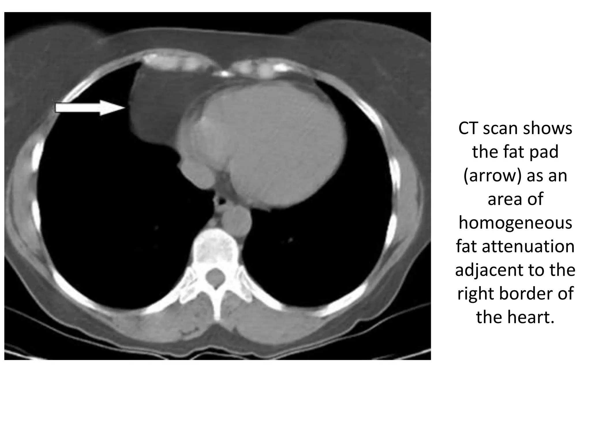 Mediastinum-RADIOLOGY | PPTX
