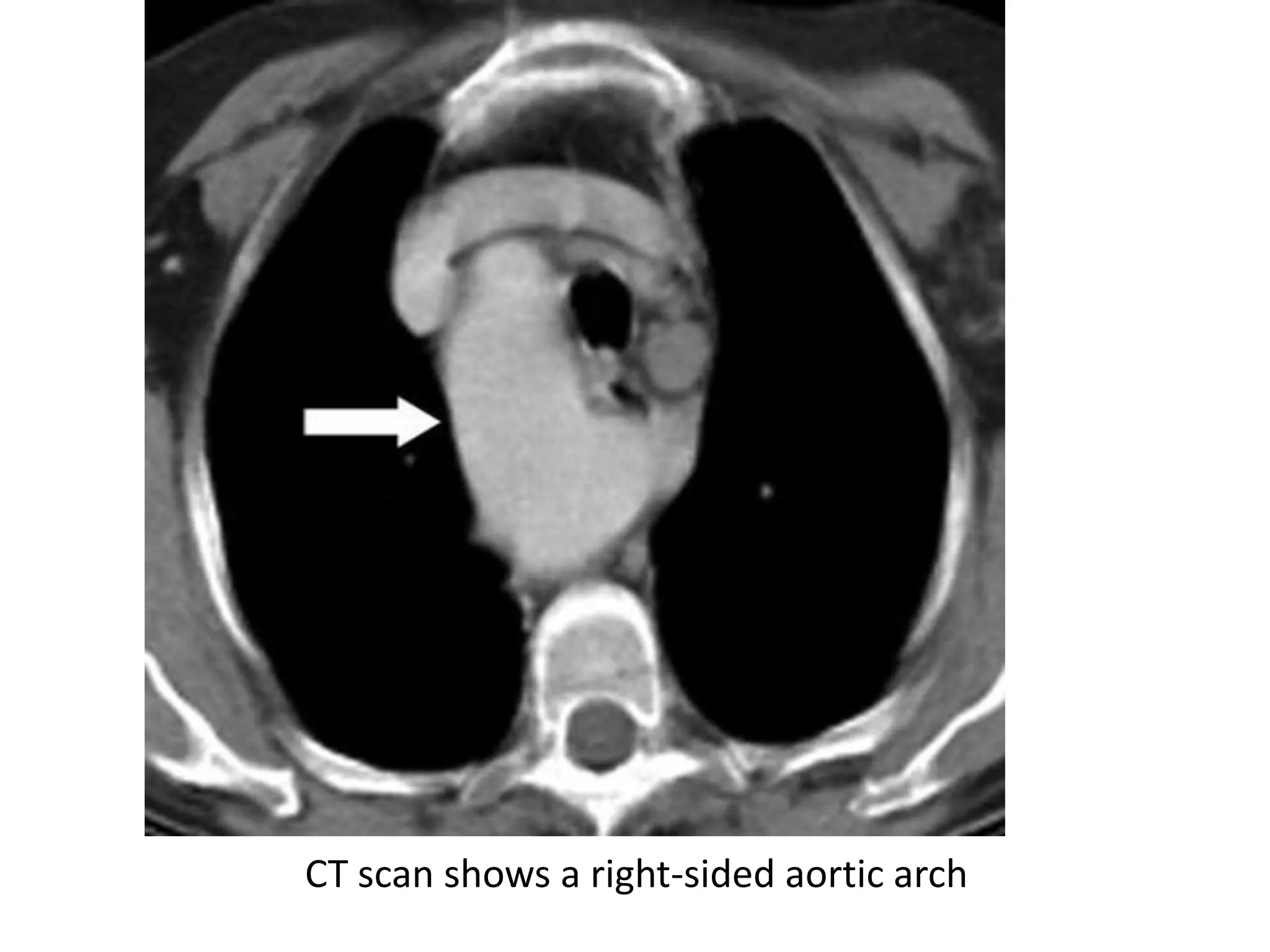 Mediastinum-RADIOLOGY | PPTX