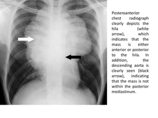 Posteroanterior
chest radiograph
clearly depicts the
hila (white
arrow), which
indicates that the
mass is either
anterior or posterior
to the hila. In
addition, the
descending aorta is
clearly seen (black
arrow), indicating
that the mass is not
within the posterior
mediastinum.
 