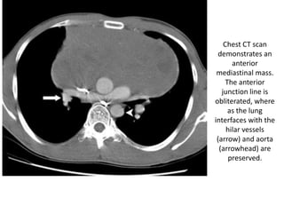 Chest CT scan
demonstrates an
anterior
mediastinal mass.
The anterior
junction line is
obliterated, where
as the lung
interfaces with the
hilar vessels
(arrow) and aorta
(arrowhead) are
preserved.
 