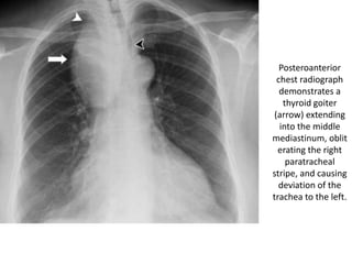 Posteroanterior
chest radiograph
demonstrates a
thyroid goiter
(arrow) extending
into the middle
mediastinum, oblit
erating the right
paratracheal
stripe, and causing
deviation of the
trachea to the left.
 