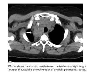 CT scan shows the mass (arrow) between the trachea and right lung, a
location that explains the obliteration of the right paratracheal stripe.
 