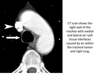 CT scan shows the
right wall of the
trachea with medial
and lateral air–soft
tissue interfaces
caused by air within
the tracheal lumen
and right lung.
 
