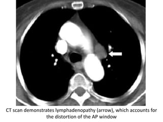 CT scan demonstrates lymphadenopathy (arrow), which accounts for
the distortion of the AP window
 