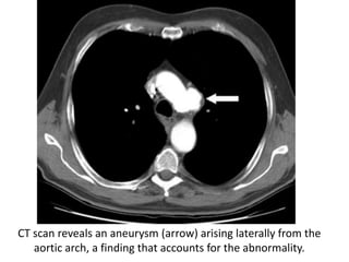 CT scan reveals an aneurysm (arrow) arising laterally from the
aortic arch, a finding that accounts for the abnormality.
 