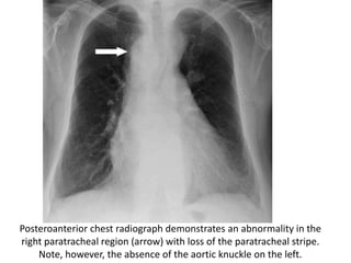 Posteroanterior chest radiograph demonstrates an abnormality in the
right paratracheal region (arrow) with loss of the paratracheal stripe.
Note, however, the absence of the aortic knuckle on the left.
 