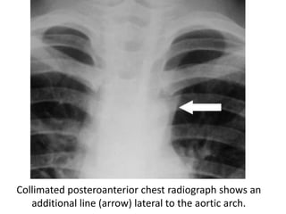Collimated posteroanterior chest radiograph shows an
additional line (arrow) lateral to the aortic arch.
 