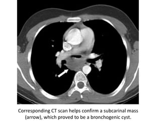 Corresponding CT scan helps confirm a subcarinal mass
(arrow), which proved to be a bronchogenic cyst.
 