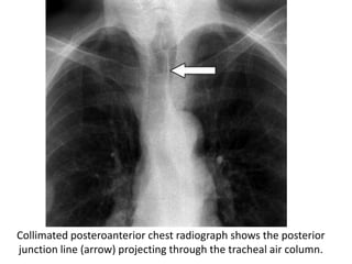 Collimated posteroanterior chest radiograph shows the posterior
junction line (arrow) projecting through the tracheal air column.
 