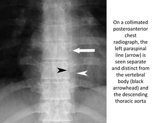 On a collimated
posteroanterior
chest
radiograph, the
left paraspinal
line (arrow) is
seen separate
and distinct from
the vertebral
body (black
arrowhead) and
the descending
thoracic aorta
 