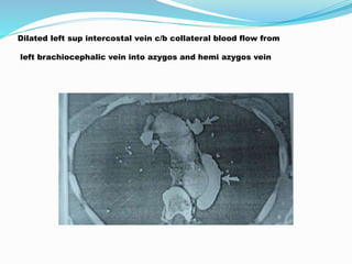 Dilated left sup intercostal vein c/b collateral blood flow from 
left brachiocephalic vein into azygos and hemi azygos vein 
 