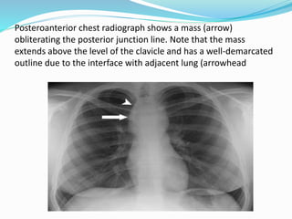 Posteroanterior chest radiograph shows a mass (arrow) 
obliterating the posterior junction line. Note that the mass 
extends above the level of the clavicle and has a well-demarcated 
outline due to the interface with adjacent lung (arrowhead 
 