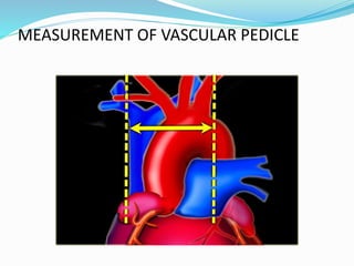MEASUREMENT OF VASCULAR PEDICLE 
 