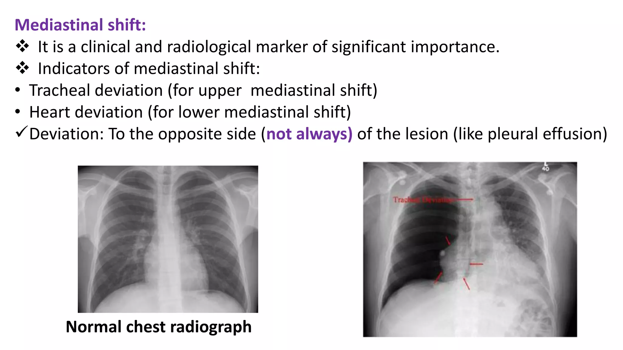 Mediastinum | PDF
