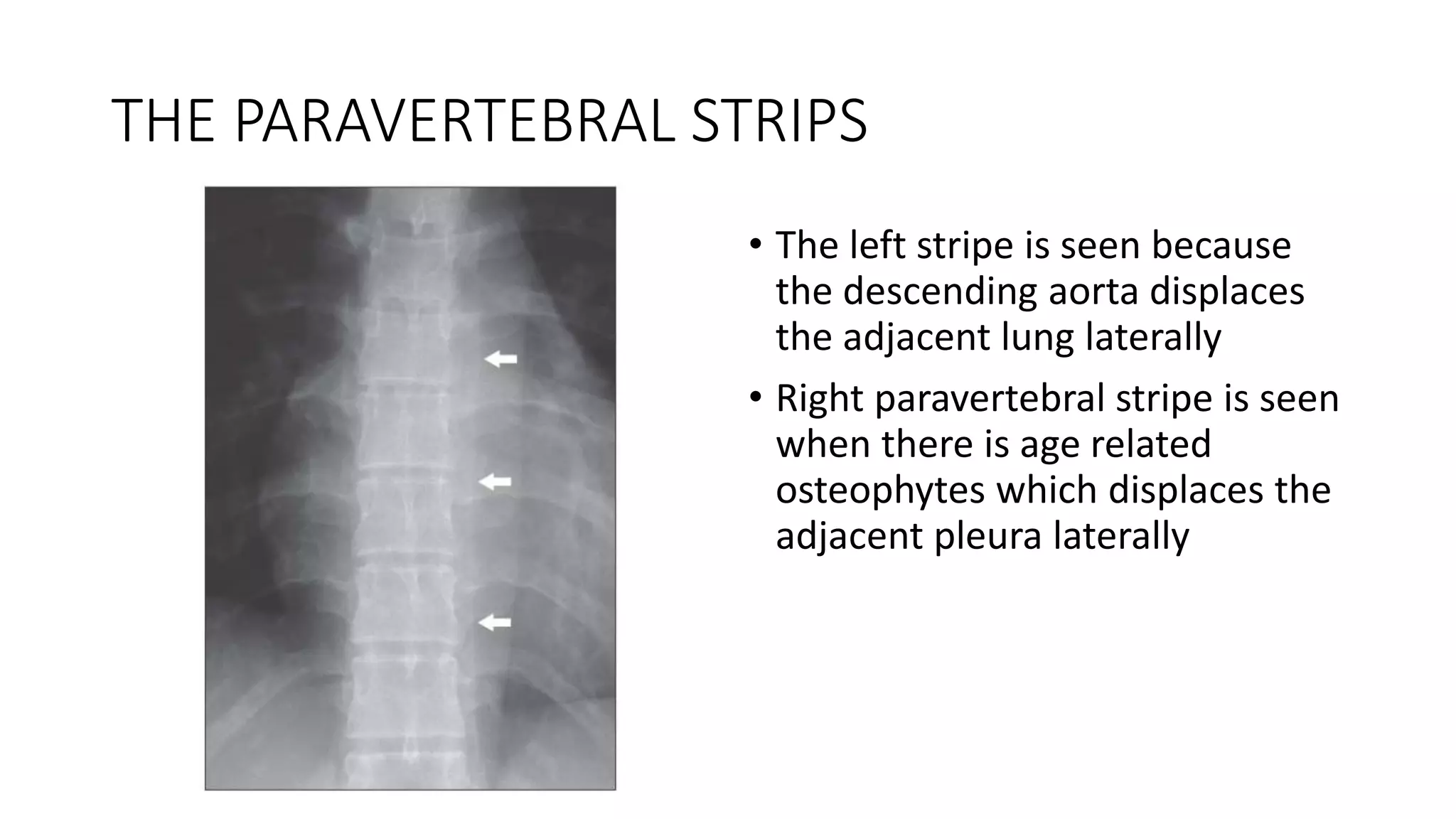THE PARAVERTEBRAL STRIPS
• The left stripe is seen because
the descending aorta displaces
the adjacent lung laterally
• Right paravertebral stripe is seen
when there is age related
osteophytes which displaces the
adjacent pleura laterally
 