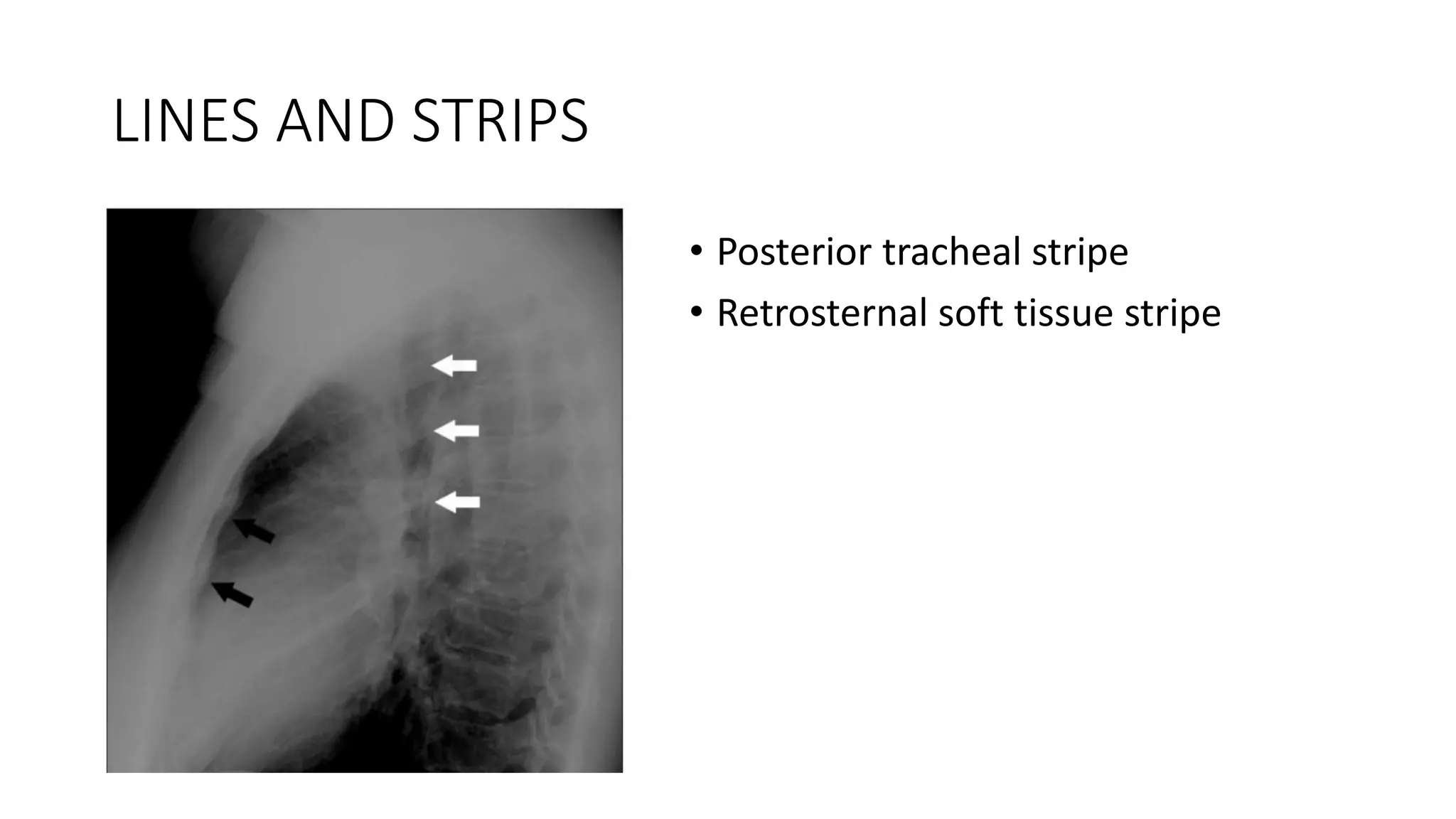 LINES AND STRIPS
• Posterior tracheal stripe
• Retrosternal soft tissue stripe
 