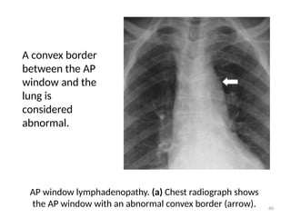 Mediastinum uploaded by alauddin for radiologists.pptx