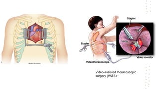Video-assisted thoracoscopic
surgery (VATS)
 