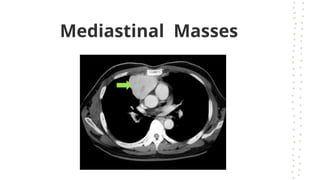 Mediastinal Masses
 