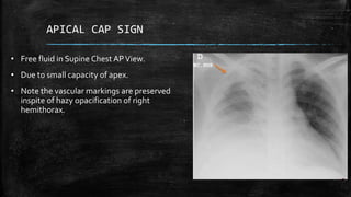Mediastinum and Pleura Radiology MBBS final semester class | PPTX