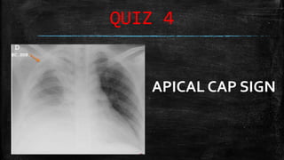 Mediastinum and Pleura Radiology MBBS final semester class | PPTX