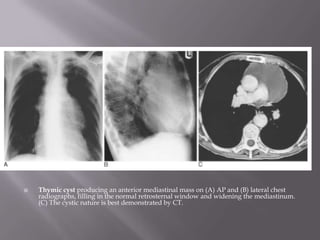  Thymic cyst producing an anterior mediastinal mass on (A) AP and (B) lateral chest
radiographs, filling in the normal retrosternal window and widening the mediastinum.
(C) The cystic nature is best demonstrated by CT.
 