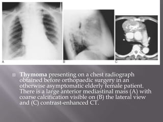  Thymoma presenting on a chest radiograph
obtained before orthopaedic surgery in an
otherwise asymptomatic elderly female patient.
There is a large anterior mediastinal mass (A) with
coarse calcification visible on (B) the lateral view
and (C) contrast-enhanced CT.
 