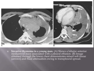  Invasive thymoma in a young man. (A) Shows a lobular anterior
mediastinal mass associated with a pleural effusion. (B) Image
obtained through the lower chest demonstrates mixed soft tissue
(arrows) and fluid attenuation owing to transpleural spread.
 