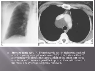  Bronchogenic cyst. (A) Bronchogenic cyst in right paratracheal
area in a young asymptomatic man. (B) In this instance the CT
attenuation was almost the same as that of the other soft tissue
structures and it was not possible to predict the cystic nature of
the mass. The cyst was surgically removed.
 