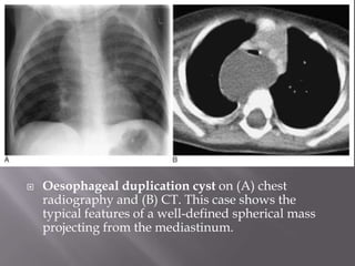  Oesophageal duplication cyst on (A) chest
radiography and (B) CT. This case shows the
typical features of a well-defined spherical mass
projecting from the mediastinum.
 