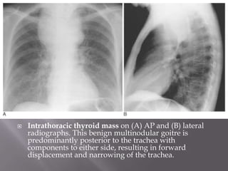  Intrathoracic thyroid mass on (A) AP and (B) lateral
radiographs. This benign multinodular goitre is
predominantly posterior to the trachea with
components to either side, resulting in forward
displacement and narrowing of the trachea.
 