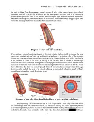 Stent Dissection Understanding Coronary Artery Anatomy and PCI Risks: Stent Edge ...