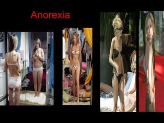 Anorexia 